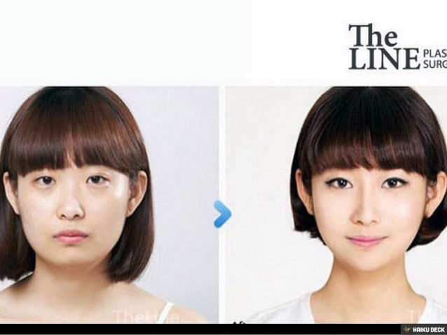 double eyelid surgery