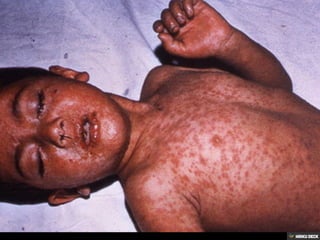 Patologias Virais III