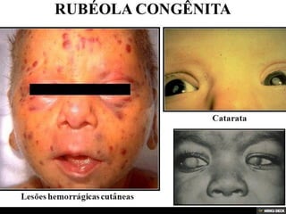 Patologias Virais III