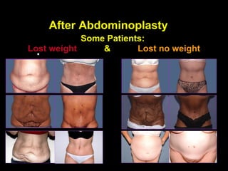 After Abdominoplasty
            Some Patients:
Lost weight     &       Lost no weight
  •
 