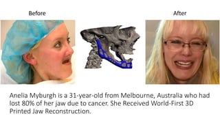 Anelia Myburgh is a 31-year-old from Melbourne, Australia who had
lost 80% of her jaw due to cancer. She Received World-First 3D
Printed Jaw Reconstruction.
Before After
 