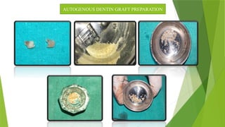 Alveolar ridge preservation with dentin autogenous bone graft | PPT