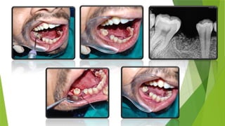 Alveolar ridge preservation with dentin autogenous bone graft | PPT
