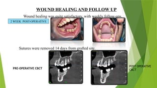 Alveolar ridge preservation with dentin autogenous bone graft | PPTX