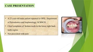 Alveolar ridge preservation with dentin autogenous bone graft | PPT