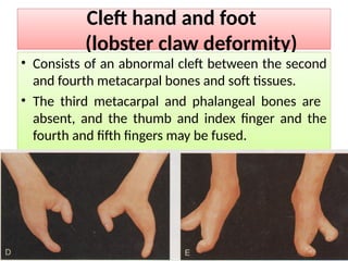 Comprehensive Overview of Upper Limb Development and Congenital ...