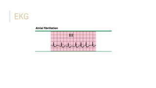 EKG
 