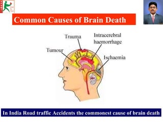 Common Causes of Brain Death In India Road traffic Accidents the commonest cause of brain death 