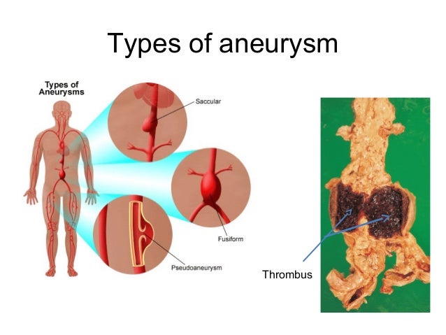 types of aneurysms