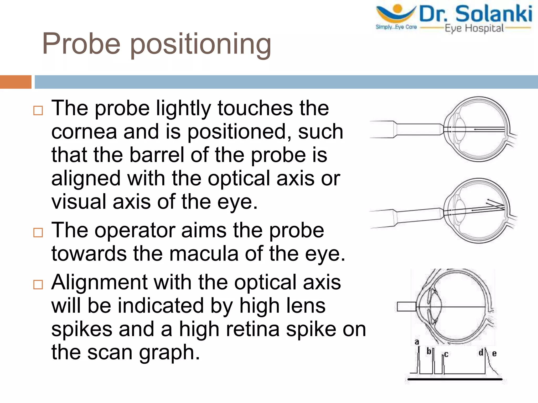 Probe positioning
 The probe lightly touches the
cornea and is positioned, such
that the barrel of the probe is
aligned with the optical axis or
visual axis of the eye.
 The operator aims the probe
towards the macula of the eye.
 Alignment with the optical axis
will be indicated by high lens
spikes and a high retina spike on
the scan graph.
 