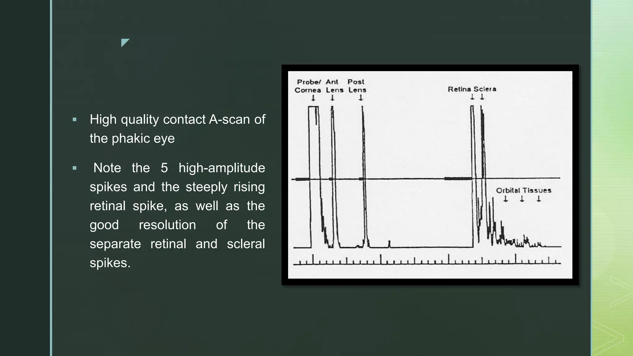 z
 High quality contact A-scan of
the phakic eye
 Note the 5 high-amplitude
spikes and the steeply rising
retinal spike, as well as the
good resolution of the
separate retinal and scleral
spikes.
 