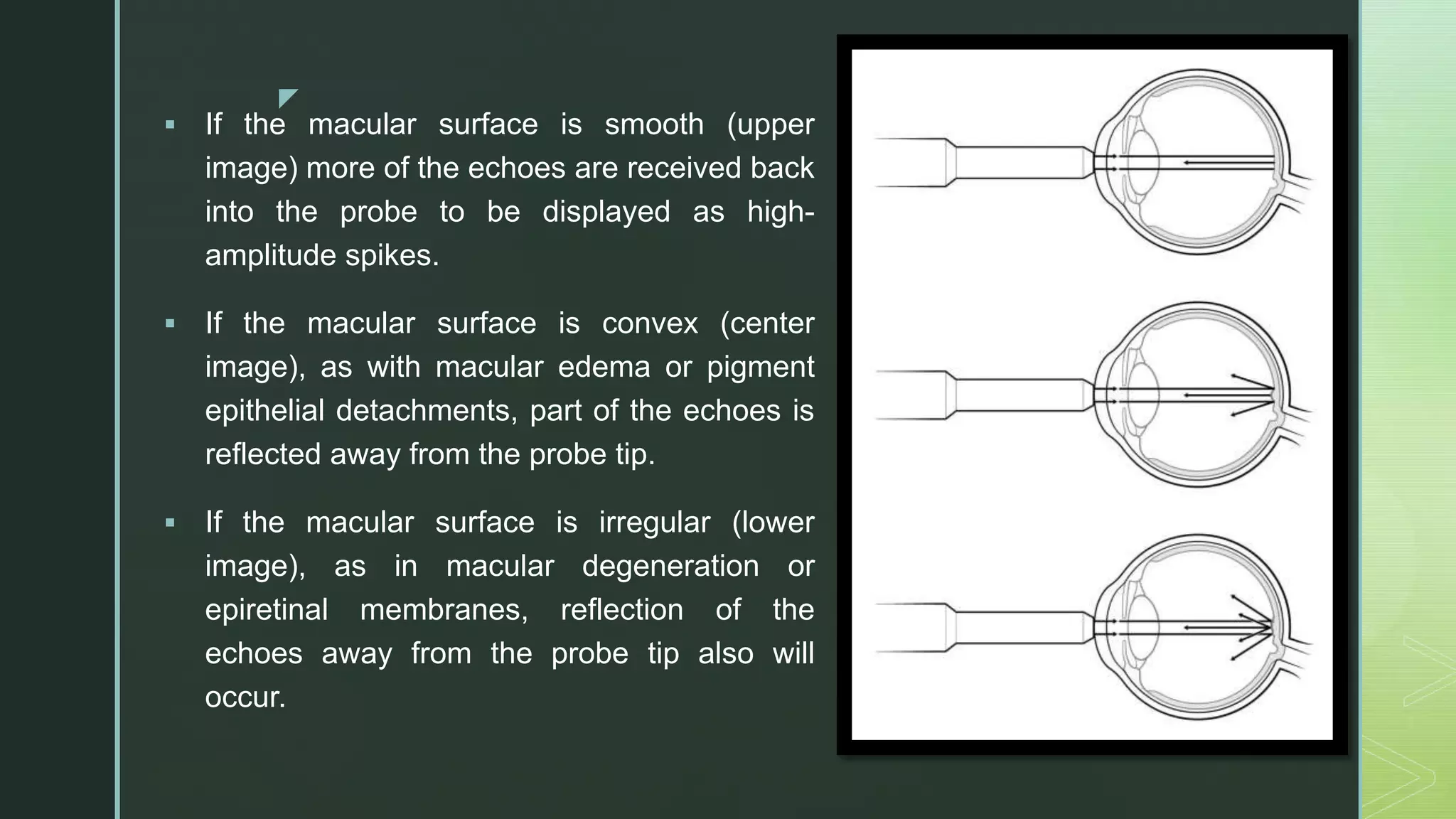z
 If the macular surface is smooth (upper
image) more of the echoes are received back
into the probe to be displayed as high-
amplitude spikes.
 If the macular surface is convex (center
image), as with macular edema or pigment
epithelial detachments, part of the echoes is
reflected away from the probe tip.
 If the macular surface is irregular (lower
image), as in macular degeneration or
epiretinal membranes, reflection of the
echoes away from the probe tip also will
occur.
 