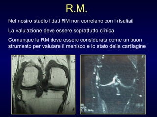 R.M. Nel nostro studio i dati RM non correlano con i risultati La valutazione deve essere soprattutto clinica Comunque la RM deve essere considerata come un buon strumento per valutare il menisco e lo stato della cartilagine 