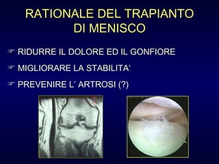 RATIONALE DEL TRAPIANTO DI MENISCO RIDURRE IL DOLORE ED IL GONFIORE MIGLIORARE LA STABILITA’ PREVENIRE L’ ARTROSI (?)  