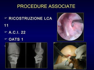 RICOSTRUZIONE LCA  11 A.C.I. 22 OATS 1 OSTEOTOMIA  4 PROCEDURE ASSOCIATE 