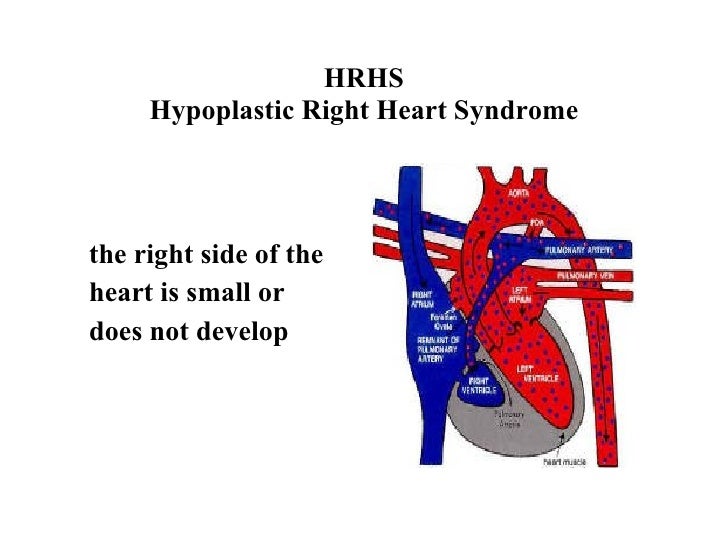 HRHS Hypoplastic Right Heart Syndrome hrhs-hypoplastic-right-heart-syndrome