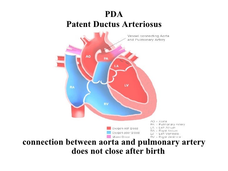 PDA Patent Ductus Arteriosus connection