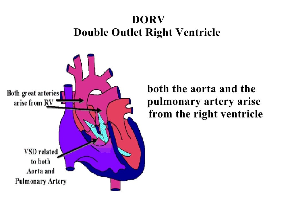 DORV Double Outlet Right Ventricle