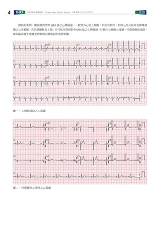 No.030THRS4 中華民國心律醫學會 ‧Taiwan Heart Rhythm Soclety‧ 中華民國 107 年 6 月出刊
　　總結此案例，雖說規則型窄 QRS 波之心搏過速，一般皆為心室上頻脈，但亦有例外。利用心室分枝束為傳導迴
圈之心室頻脈，若其迴圈較為上端，亦可能呈現相對窄 QRS 波之心搏過速。仔細小心檢視心電圖，可發現蛛絲馬跡，
做為臨床電生理檢查與電燒治療術前的重要依據。
圖一、 心搏過速時之心電圖
圖二、 回復竇性心律時之心電圖
 