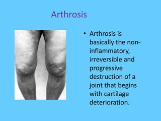 Arthrosis
• Arthrosis is
basically the non-
inflammatory,
irreversible and
progressive
destruction of a
joint that begins
with cartilage
deterioration.
 