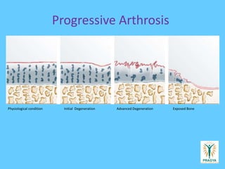 Progressive Arthrosis
Physiological condition Initial Degeneration Advanced Degeneration Exposed Bone
 