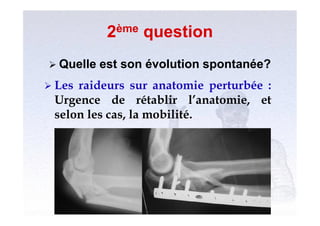 2ème question
 Quelle   est son évolution spontanée?
 Lesraideurs sur anatomie perturbée :
 Urgence de rétablir l’anatomie, et
 selon les cas, la mobilité.
 