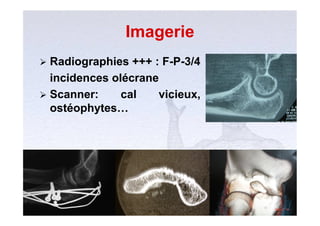 Imagerie
 Radiographies +++ : F-P-3/4
  incidences olécrane
 Scanner:     cal   vicieux,
  ostéophytes…
 