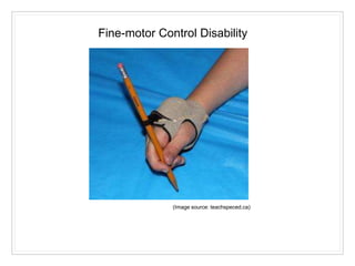 (Image source: teachspeced.ca)
Fine-motor Control Disability
 