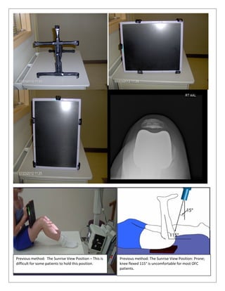 Previous method: The Sunrise View Position – This is
difficult for some patients to hold this position.
Previous method: The Sunrise View Position: Prone;
knee flexed 115° is uncomfortable for most OFC
patients.
 
