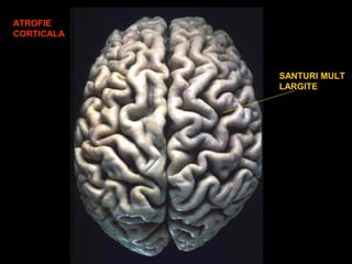 ATROFIE
CORTICALA
SANTURI MULT
LARGITE
 
