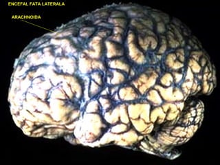 ENCEFAL FATA LATERALA
ARACHNOIDA
 
