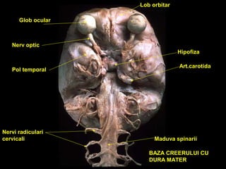 Glob ocular
Nerv optic
Hipofiza
Lob orbitar
Pol temporal
Art.carotida
Nervi radiculari
cervicali Maduva spinarii
BAZA CREERULUI CU
DURA MATER
 