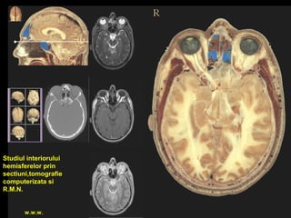 Studiul interiorului
hemisferelor prin
sectiuni,tomografie
computerizata si
R.M.N.
w.w.w.
 