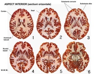 ASPECT INTERIOR (sectiuni orizontale)
Substanta cenusie
Substanta alba
Cortex
Ventricoli
laterali
Nucleii
bazali
Sept
w.w.w.
 