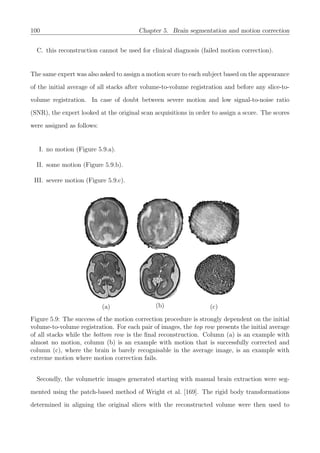 100 Chapter 5. Brain segmentation and motion correction
C. this reconstruction cannot be used for clinical diagnosis (failed motion correction).
The same expert was also asked to assign a motion score to each subject based on the appearance
of the initial average of all stacks after volume-to-volume registration and before any slice-to-
volume registration. In case of doubt between severe motion and low signal-to-noise ratio
(SNR), the expert looked at the original scan acquisitions in order to assign a score. The scores
were assigned as follows:
I. no motion (Figure 5.9.a).
II. some motion (Figure 5.9.b).
III. severe motion (Figure 5.9.c).
(a) (b) (c)
Figure 5.9: The success of the motion correction procedure is strongly dependent on the initial
volume-to-volume registration. For each pair of images, the top row presents the initial average
of all stacks while the bottom row is the ﬁnal reconstruction. Column (a) is an example with
almost no motion, column (b) is an example with motion that is successfully corrected and
column (c), where the brain is barely recognisable in the average image, is an example with
extreme motion where motion correction fails.
Secondly, the volumetric images generated starting with manual brain extraction were seg-
mented using the patch-based method of Wright et al. [169]. The rigid body transformations
determined in aligning the original slices with the reconstructed volume were then used to
 