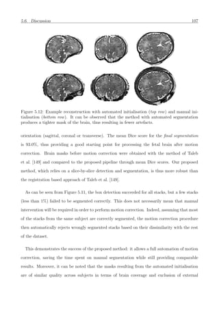 5.6. Discussion 107
Figure 5.12: Example reconstruction with automated initialisation (top row) and manual ini-
tialisation (bottom row). It can be observed that the method with automated segmentation
produces a tighter mask of the brain, thus resulting in fewer artefacts.
orientation (sagittal, coronal or transverse). The mean Dice score for the ﬁnal segmentation
is 93.0%, thus providing a good starting point for processing the fetal brain after motion
correction. Brain masks before motion correction were obtained with the method of Taleb
et al. [149] and compared to the proposed pipeline through mean Dice scores. Our proposed
method, which relies on a slice-by-slice detection and segmentation, is thus more robust than
the registration based approach of Taleb et al. [149].
As can be seen from Figure 5.11, the box detection succeeded for all stacks, but a few stacks
(less than 1%) failed to be segmented correctly. This does not necessarily mean that manual
intervention will be required in order to perform motion correction. Indeed, assuming that most
of the stacks from the same subject are correctly segmented, the motion correction procedure
then automatically rejects wrongly segmented stacks based on their dissimilarity with the rest
of the dataset.
This demonstrates the success of the proposed method: it allows a full automation of motion
correction, saving the time spent on manual segmentation while still providing comparable
results. Moreover, it can be noted that the masks resulting from the automated initialisation
are of similar quality across subjects in terms of brain coverage and exclusion of external
 
