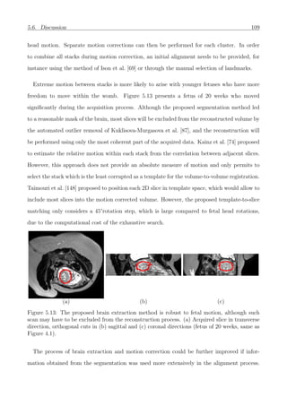 5.6. Discussion 109
head motion. Separate motion corrections can then be performed for each cluster. In order
to combine all stacks during motion correction, an initial alignment needs to be provided, for
instance using the method of Ison et al. [69] or through the manual selection of landmarks.
Extreme motion between stacks is more likely to arise with younger fetuses who have more
freedom to move within the womb. Figure 5.13 presents a fetus of 20 weeks who moved
signiﬁcantly during the acquisition process. Although the proposed segmentation method led
to a reasonable mask of the brain, most slices will be excluded from the reconstructed volume by
the automated outlier removal of Kuklisova-Murgasova et al. [87], and the reconstruction will
be performed using only the most coherent part of the acquired data. Kainz et al. [74] proposed
to estimate the relative motion within each stack from the correlation between adjacent slices.
However, this approach does not provide an absolute measure of motion and only permits to
select the stack which is the least corrupted as a template for the volume-to-volume registration.
Taimouri et al. [148] proposed to position each 2D slice in template space, which would allow to
include most slices into the motion corrected volume. However, the proposed template-to-slice
matching only considers a 45°rotation step, which is large compared to fetal head rotations,
due to the computational cost of the exhaustive search.
(a) (b) (c)
Figure 5.13: The proposed brain extraction method is robust to fetal motion, although such
scan may have to be excluded from the reconstruction process. (a) Acquired slice in transverse
direction, orthogonal cuts in (b) sagittal and (c) coronal directions (fetus of 20 weeks, same as
Figure 4.1).
The process of brain extraction and motion correction could be further improved if infor-
mation obtained from the segmentation was used more extensively in the alignment process.
 