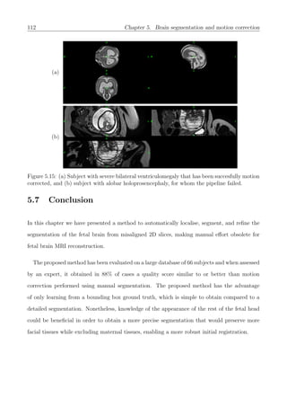 112 Chapter 5. Brain segmentation and motion correction
(a)
(b)
Figure 5.15: (a) Subject with severe bilateral ventriculomegaly that has been succesfully motion
corrected, and (b) subject with alobar holoprosencephaly, for whom the pipeline failed.
5.7 Conclusion
In this chapter we have presented a method to automatically localise, segment, and reﬁne the
segmentation of the fetal brain from misaligned 2D slices, making manual eﬀort obsolete for
fetal brain MRI reconstruction.
The proposed method has been evaluated on a large database of 66 subjects and when assessed
by an expert, it obtained in 88% of cases a quality score similar to or better than motion
correction performed using manual segmentation. The proposed method has the advantage
of only learning from a bounding box ground truth, which is simple to obtain compared to a
detailed segmentation. Nonetheless, knowledge of the appearance of the rest of the fetal head
could be beneﬁcial in order to obtain a more precise segmentation that would preserve more
facial tissues while excluding maternal tissues, enabling a more robust initial registration.
 