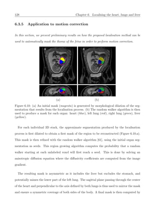 128 Chapter 6. Localising the heart, lungs and liver
6.3.5 Application to motion correction
In this section, we present preliminary results on how the proposed localisation method can be
used to automatically mask the thorax of the fetus in order to perform motion correction.
(a) (b)
Figure 6.10: (a) An initial mask (magenta) is generated by morphological dilation of the seg-
mentation that results from the localisation process. (b) The random walker algorithm is then
used to produce a mask for each organ: heart (blue), left lung (red), right lung (green), liver
(yellow).
For each individual 3D stack, the approximate segmentation produced by the localisation
process is ﬁrst dilated to obtain a ﬁrst mask of the region to be reconstructed (Figure 6.10.a).
This mask is then reﬁned with the random walker algorithm [61], using the initial organ seg-
mentation as seeds. This region growing algorithm computes the probability that a random
walker starting at each unlabeled voxel will ﬁrst reach a seed. This is done by solving an
anisotropic diﬀusion equation where the diﬀusivity coeﬃcients are computed from the image
gradient.
The resulting mask is asymmetric as it includes the liver but excludes the stomach, and
potentially misses the lower part of the left lung. The sagittal plane passing through the center
of the heart and perpendicular to the axis deﬁned by both lungs is thus used to mirror the mask
and ensure a symmetric coverage of both sides of the body. A ﬁnal mask is then computed by
 