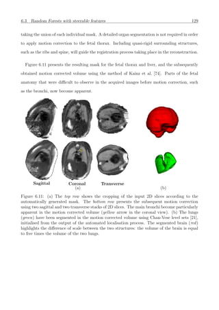 6.3. Random Forests with steerable features 129
taking the union of each individual mask. A detailed organ segmentation is not required in order
to apply motion correction to the fetal thorax. Including quasi-rigid surrounding structures,
such as the ribs and spine, will guide the registration process taking place in the reconstruction.
Figure 6.11 presents the resulting mask for the fetal thorax and liver, and the subsequently
obtained motion corrected volume using the method of Kainz et al. [74]. Parts of the fetal
anatomy that were diﬃcult to observe in the acquired images before motion correction, such
as the bronchi, now become apparent.
Sagittal Coronal Transverse
(a) (b)
Figure 6.11: (a) The top row shows the cropping of the input 2D slices according to the
automatically generated mask. The bottom row presents the subsequent motion correction
using two sagittal and two transverse stacks of 2D slices. The main bronchi become particularly
apparent in the motion corrected volume (yellow arrow in the coronal view). (b) The lungs
(green) have been segmented in the motion corrected volume using Chan-Vese level sets [21],
initialised from the output of the automated localisation process. The segmented brain (red)
highlights the diﬀerence of scale between the two structures: the volume of the brain is equal
to ﬁve times the volume of the two lungs.
 