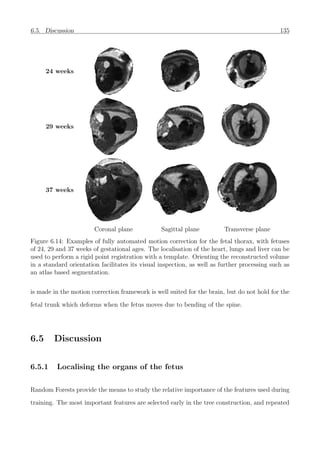 6.5. Discussion 135
24 weeks
29 weeks
37 weeks
Coronal plane Sagittal plane Transverse plane
Figure 6.14: Examples of fully automated motion correction for the fetal thorax, with fetuses
of 24, 29 and 37 weeks of gestational ages. The localisation of the heart, lungs and liver can be
used to perform a rigid point registration with a template. Orienting the reconstructed volume
in a standard orientation facilitates its visual inspection, as well as further processing such as
an atlas based segmentation.
is made in the motion correction framework is well suited for the brain, but do not hold for the
fetal trunk which deforms when the fetus moves due to bending of the spine.
6.5 Discussion
6.5.1 Localising the organs of the fetus
Random Forests provide the means to study the relative importance of the features used during
training. The most important features are selected early in the tree construction, and repeated
 
