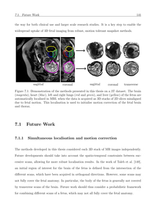 7.1. Future Work 141
the way for both clinical use and larger scale research studies. It is a key step to enable the
widespread uptake of 3D fetal imaging from robust, motion tolerant snapshot methods.
sagittal coronal sagittal coronal transverse
Figure 7.1: Demonstration of the methods presented in this thesis on a 3T dataset. The brain
(magenta), heart (blue), left and right lungs (red and green), and liver (yellow) of the fetus are
automatically localised in MRI, when the data is acquired as 3D stacks of 2D slices misaligned
due to fetal motion. This localisation is used to initialise motion correction of the fetal brain
and thorax.
7.1 Future Work
7.1.1 Simultaneous localisation and motion correction
The methods developed in this thesis considered each 3D stack of MR images independently.
Future developments should take into account the spatio-temporal constraints between suc-
cessive scans, allowing for more robust localisation results. In the work of Taleb et al. [149],
an initial region of interest for the brain of the fetus is deﬁned from the intersection of the
diﬀerent scans, which have been acquired in orthogonal directions. However, some scans may
not fully cover the fetal anatomy. In particular, the body of the fetus is generally not covered
by transverse scans of the brain. Future work should thus consider a probabilistic framework
for combining diﬀerent scans of a fetus, which may not all fully cover the fetal anatomy.
 