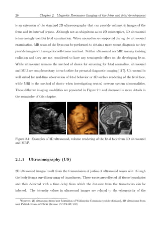26 Chapter 2. Magnetic Resonance Imaging of the fetus and fetal development
is an extension of the standard 2D ultrasonography that can provide volumetric images of the
fetus and its internal organs. Although not as ubiquitous as its 2D counterpart, 3D ultrasound
is increasingly used for fetal examination. When anomalies are suspected during the ultrasound
examination, MR scans of the fetus can be performed to obtain a more robust diagnosis as they
provide images with a superior soft-tissue contrast. Neither ultrasound nor MRI use any ionising
radiation and they are not considered to have any teratogenic eﬀect on the developing fetus.
While ultrasound remains the method of choice for screening for fetal anomalies, ultrasound
and MRI are complementary to each other for prenatal diagnostic imaging [117]. Ultrasound is
well suited for real-time observation of fetal behavior or 3D surface rendering of the fetal face,
while MRI is the method of choice when investigating central nervous system abnormalities.
These diﬀerent imaging modalities are presented in Figure 2.1 and discussed in more details in
the remainder of this chapter.
Figure 2.1: Examples of 2D ultrasound, volume rendering of the fetal face from 3D ultrasound
and MRI1
.
2.1.1 Ultrasonography (US)
2D ultrasound images result from the transmission of pulses of ultrasound waves sent through
the body from a curvilinear array of transducers. These waves are reﬂected oﬀ tissue boundaries
and then detected with a time delay from which the distance from the transducers can be
inferred. The intensity values in ultrasound images are related to the echogenicity of the
1
Sources: 2D ultrasound from user Mirmillon of Wikimedia Commons (public domain), 3D ultrasound from
user Patrick Evans of Flickr (license CC BY-NC 2.0)
 