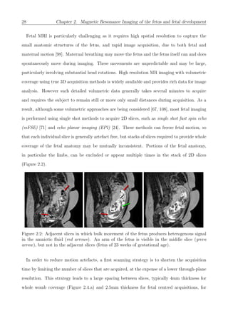28 Chapter 2. Magnetic Resonance Imaging of the fetus and fetal development
Fetal MRI is particularly challenging as it requires high spatial resolution to capture the
small anatomic structures of the fetus, and rapid image acquisition, due to both fetal and
maternal motion [98]. Maternal breathing may move the fetus and the fetus itself can and does
spontaneously move during imaging. These movements are unpredictable and may be large,
particularly involving substantial head rotations. High resolution MR imaging with volumetric
coverage using true 3D acquisition methods is widely available and provides rich data for image
analysis. However such detailed volumetric data generally takes several minutes to acquire
and requires the subject to remain still or move only small distances during acquisition. As a
result, although some volumetric approaches are being considered [67, 108], most fetal imaging
is performed using single shot methods to acquire 2D slices, such as single shot fast spin echo
(ssFSE) [71] and echo planar imaging (EPI) [24]. These methods can freeze fetal motion, so
that each individual slice is generally artefact free, but stacks of slices required to provide whole
coverage of the fetal anatomy may be mutually inconsistent. Portions of the fetal anatomy,
in particular the limbs, can be excluded or appear multiple times in the stack of 2D slices
(Figure 2.2).
Figure 2.2: Adjacent slices in which bulk movement of the fetus produces heterogenous signal
in the amniotic ﬂuid (red arrows). An arm of the fetus is visible in the middle slice (green
arrow), but not in the adjacent slices (fetus of 23 weeks of gestational age).
In order to reduce motion artefacts, a ﬁrst scanning strategy is to shorten the acquisition
time by limiting the number of slices that are acquired, at the expense of a lower through-plane
resolution. This strategy leads to a large spacing between slices, typically 4mm thickness for
whole womb coverage (Figure 2.4.a) and 2.5mm thickness for fetal centred acquisitions, for
 