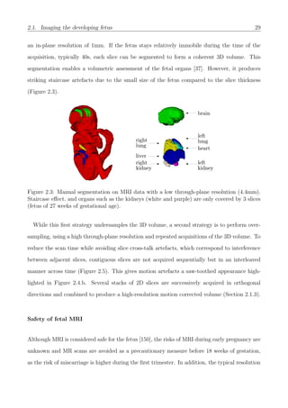 2.1. Imaging the developing fetus 29
an in-plane resolution of 1mm. If the fetus stays relatively immobile during the time of the
acquisition, typically 40s, each slice can be segmented to form a coherent 3D volume. This
segmentation enables a volumetric assessment of the fetal organs [37]. However, it produces
striking staircase artefacts due to the small size of the fetus compared to the slice thickness
(Figure 2.3).
Figure 2.3: Manual segmentation on MRI data with a low through-plane resolution (4.4mm).
Staircase eﬀect, and organs such as the kidneys (white and purple) are only covered by 3 slices
(fetus of 27 weeks of gestational age).
While this ﬁrst strategy undersamples the 3D volume, a second strategy is to perform over-
sampling, using a high through-plane resolution and repeated acquisitions of the 3D volume. To
reduce the scan time while avoiding slice cross-talk artefacts, which correspond to interference
between adjacent slices, contiguous slices are not acquired sequentially but in an interleaved
manner across time (Figure 2.5). This gives motion artefacts a saw-toothed appearance high-
lighted in Figure 2.4.b. Several stacks of 2D slices are successively acquired in orthogonal
directions and combined to produce a high-resolution motion corrected volume (Section 2.1.3).
Safety of fetal MRI
Although MRI is considered safe for the fetus [150], the risks of MRI during early pregnancy are
unknown and MR scans are avoided as a precautionary measure before 18 weeks of gestation,
as the risk of miscarriage is higher during the ﬁrst trimester. In addition, the typical resolution
 