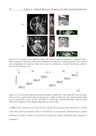 30 Chapter 2. Magnetic Resonance Imaging of the fetus and fetal development
(a)
(b)
Figure 2.4: Example scans with the native 2D slices in sagittal orientation, acquired with a
slice thickness of 4.4mm (a) and a slice thickness of 1.3mm (b). A zoomed patch of the coronal
section highlights the staircase eﬀect due to the slice thickness in (a) and interleaving artefacts
due to fetal motion in (b).
Figure 2.5: As the time required to acquire data for a single slice is less than TR, data for other
slices can be acquired during the remaining time. Adjacent slices are not acquired sequentially
but are separated in time, so that each slice is excited by a speciﬁc RF pulse without being
aﬀected by adjacent slices (ﬁgure adapted from Levine [92]).
of MRI (1mm3
) would be too coarse for the embryo which measures less than 2cm at 8 weeks
[113], while the fetus measures 15cm at 18 weeks [6]. In comparison, ultrasound has a typical
resolution of 0.1mm3
, which is well suited for imaging the embryo during the ﬁrst trimester of
pregnancy.
 