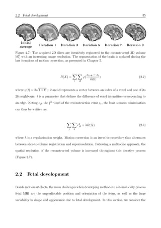 2.2. Fetal development 35
Initial
average
Iteration 1 Iteration 3 Iteration 5 Iteration 7 Iteration 9
Figure 2.7: The acquired 2D slices are iteratively registered to the reconstructed 3D volume
[87] with an increasing image resolution. The segmentation of the brain is updated during the
last iterations of motion correction, as presented in Chapter 5.
R(X) =
i d
ϕ(
xi+d − xi
δ|d|
) (2.2)
where ϕ(t) = 2
√
1 + t2 − 2 and d represents a vector between an index of a voxel and one of its
26 neighbours. δ is a parameter that deﬁnes the diﬀerence of voxel intensities corresponding to
an edge. Noting ejk the jth
voxel of the reconstruction error k, the least squares minimisation
can thus be written as:
j k
e2
jk + λR(X) (2.3)
where λ is a regularisation weight. Motion correction is an iterative procedure that alternates
between slice-to-volume registration and superresolution. Following a multiscale approach, the
spatial resolution of the reconstructed volume is increased throughout this iterative process
(Figure 2.7).
2.2 Fetal development
Beside motion artefacts, the main challenges when developing methods to automatically process
fetal MRI are the unpredictable position and orientation of the fetus, as well as the large
variability in shape and appearance due to fetal development. In this section, we consider the
 