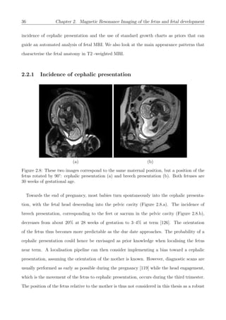 36 Chapter 2. Magnetic Resonance Imaging of the fetus and fetal development
incidence of cephalic presentation and the use of standard growth charts as priors that can
guide an automated analysis of fetal MRI. We also look at the main appearance patterns that
characterise the fetal anatomy in T2 -weighted MRI.
2.2.1 Incidence of cephalic presentation
(a) (b)
Figure 2.8: These two images correspond to the same maternal position, but a position of the
fetus rotated by 90°: cephalic presentation (a) and breech presentation (b). Both fetuses are
30 weeks of gestational age.
Towards the end of pregnancy, most babies turn spontaneously into the cephalic presenta-
tion, with the fetal head descending into the pelvic cavity (Figure 2.8.a). The incidence of
breech presentation, corresponding to the feet or sacrum in the pelvic cavity (Figure 2.8.b),
decreases from about 20% at 28 weeks of gestation to 3–4% at term [126]. The orientation
of the fetus thus becomes more predictable as the due date approaches. The probability of a
cephalic presentation could hence be envisaged as prior knowledge when localising the fetus
near term. A localisation pipeline can then consider implementing a bias toward a cephalic
presentation, assuming the orientation of the mother is known. However, diagnostic scans are
usually performed as early as possible during the pregnancy [119] while the head engagement,
which is the movement of the fetus to cephalic presentation, occurs during the third trimester.
The position of the fetus relative to the mother is thus not considered in this thesis as a robust
 