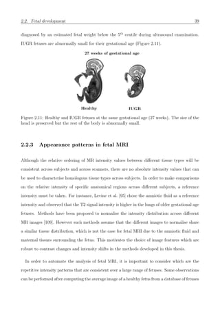 2.2. Fetal development 39
diagnosed by an estimated fetal weight below the 5th
centile during ultrasound examination.
IUGR fetuses are abnormally small for their gestational age (Figure 2.11).
Healthy IUGR
27 weeks of gestational age
Figure 2.11: Healthy and IUGR fetuses at the same gestational age (27 weeks). The size of the
head is preserved but the rest of the body is abnormally small.
2.2.3 Appearance patterns in fetal MRI
Although the relative ordering of MR intensity values between diﬀerent tissue types will be
consistent across subjects and across scanners, there are no absolute intensity values that can
be used to characterise homologous tissue types across subjects. In order to make comparisons
on the relative intensity of speciﬁc anatomical regions across diﬀerent subjects, a reference
intensity must be taken. For instance, Levine et al. [95] chose the amniotic ﬂuid as a reference
intensity and observed that the T2 signal intensity is higher in the lungs of older gestational age
fetuses. Methods have been proposed to normalise the intensity distribution across diﬀerent
MR images [109]. However such methods assume that the diﬀerent images to normalise share
a similar tissue distribution, which is not the case for fetal MRI due to the amniotic ﬂuid and
maternal tissues surrounding the fetus. This motivates the choice of image features which are
robust to contrast changes and intensity shifts in the methods developed in this thesis.
In order to automate the analysis of fetal MRI, it is important to consider which are the
repetitive intensity patterns that are consistent over a large range of fetuses. Some observations
can be performed after computing the average image of a healthy fetus from a database of fetuses
 