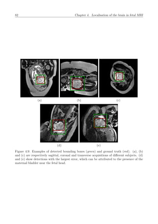 82 Chapter 4. Localisation of the brain in fetal MRI
(a) (b) (c)
(d) (e)
Figure 4.9: Examples of detected bounding boxes (green) and ground truth (red). (a), (b)
and (c) are respectively sagittal, coronal and transverse acquisitions of diﬀerent subjects. (d)
and (e) show detections with the largest error, which can be attributed to the presence of the
maternal bladder near the fetal head.
 